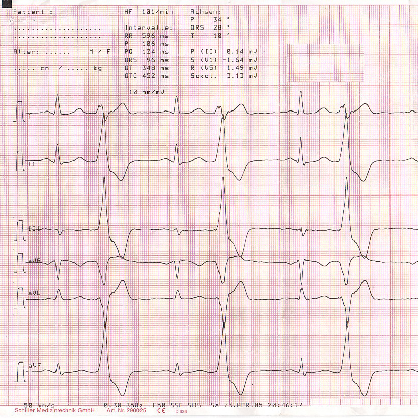 ekg-example-photo-158896